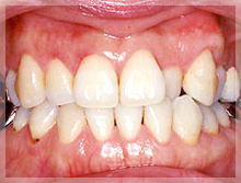 歯周外科症例 After