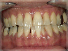 歯肉のメラニン除去 After